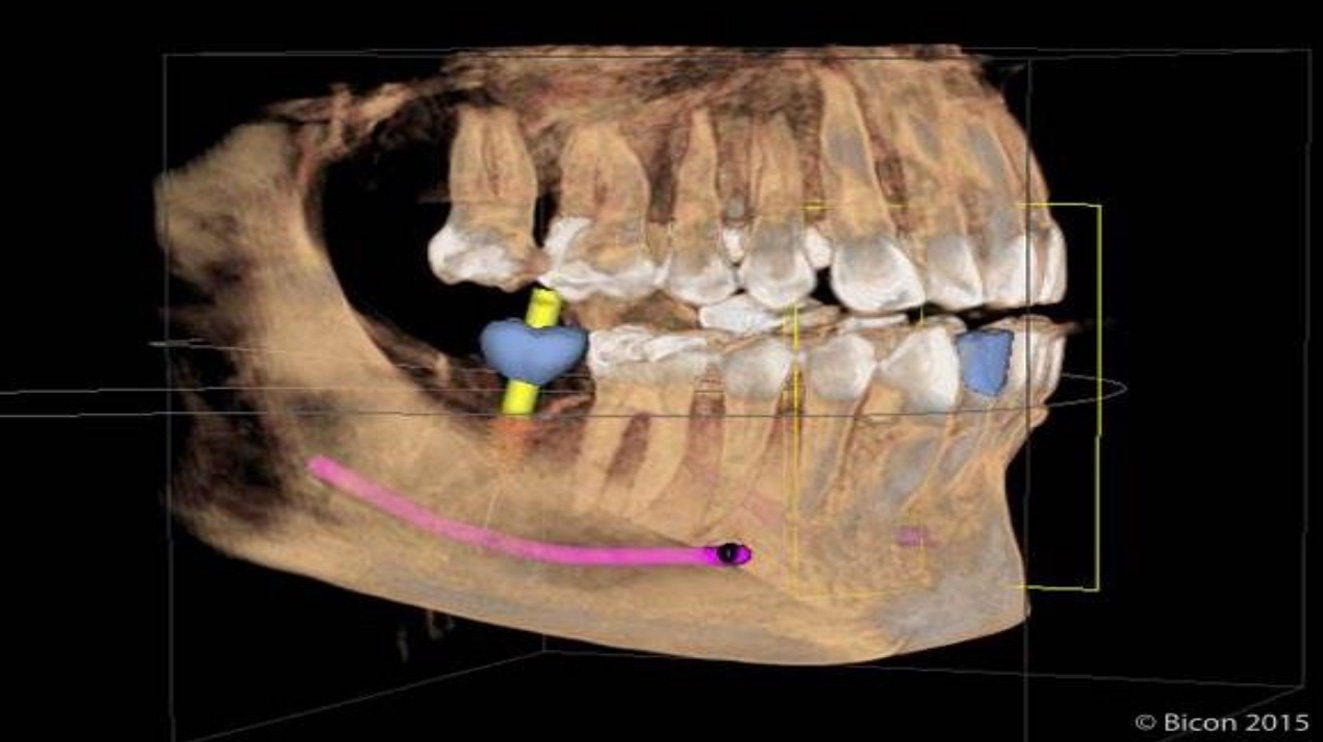 Cerec Guided Dental Implants Creve Coeur, MO