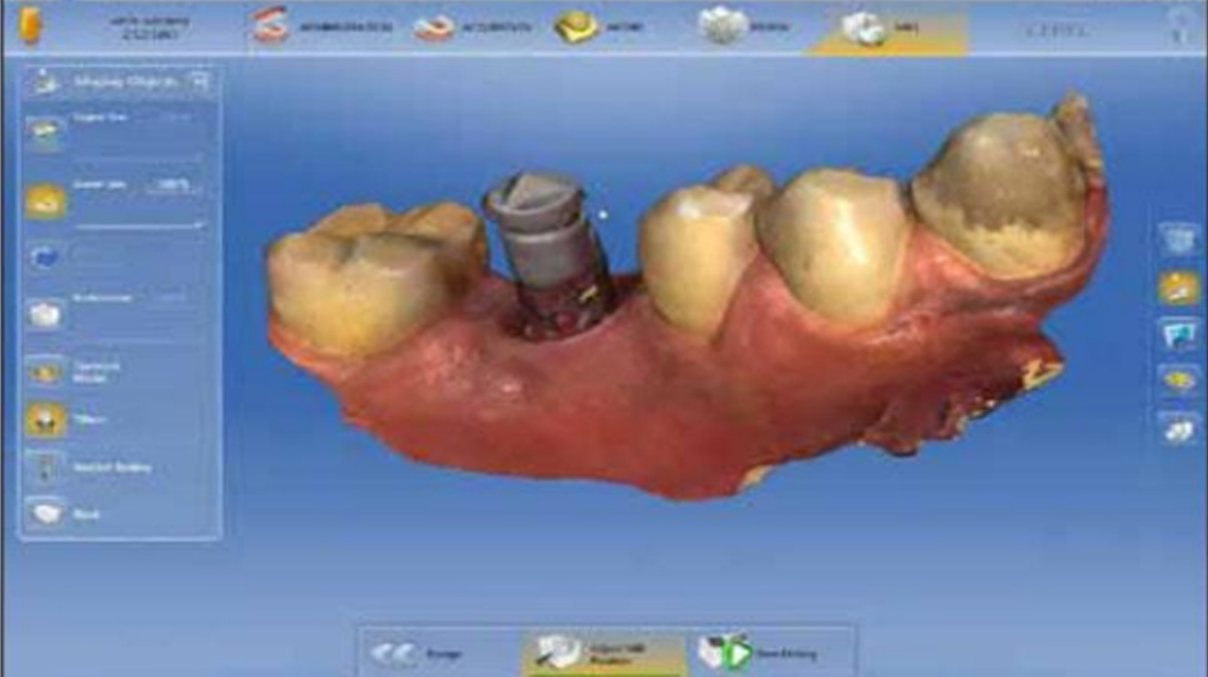 Scan Post | Dental Implant Creve Coeur, MO